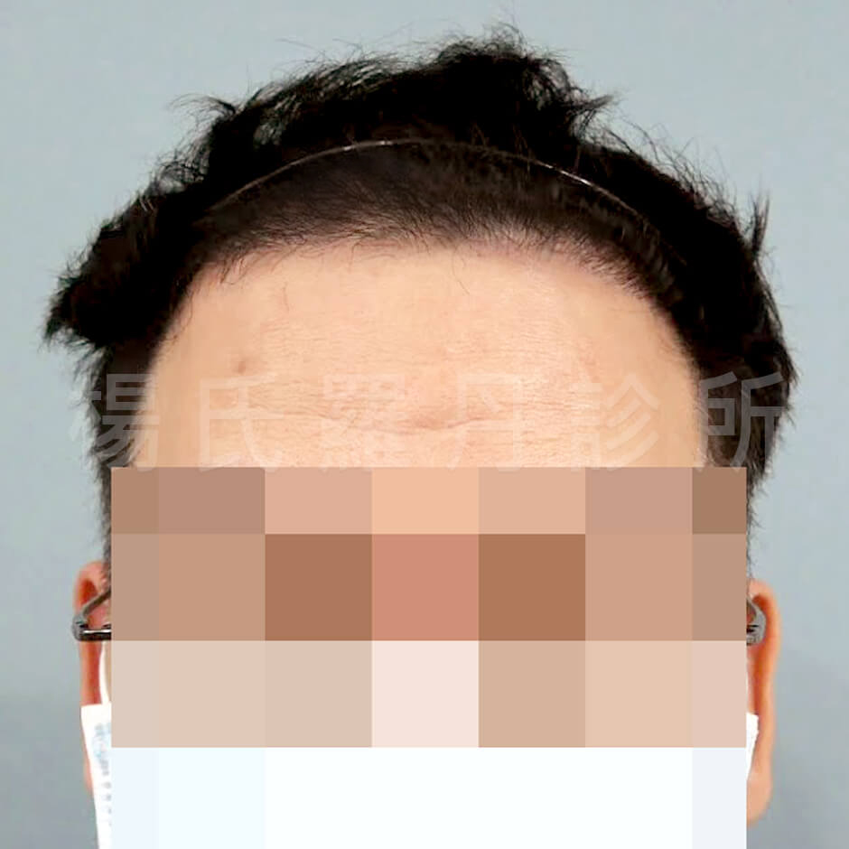 ARTAS  植髮  禿頭 M型禿